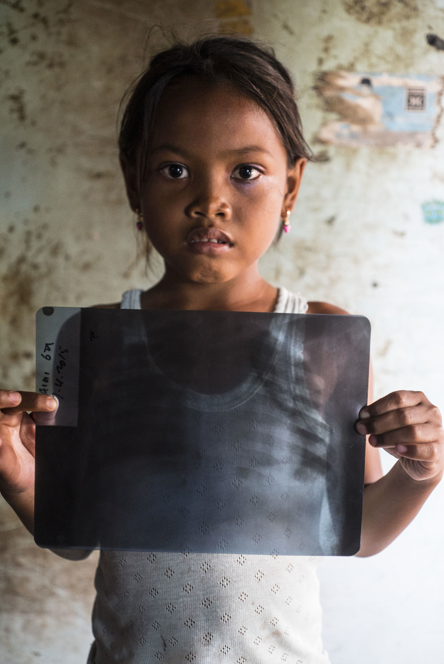 8 year-old Aini holds her chest X-Ray, showing specks in her lungs at her home near the Indramayu coal-fired power station in West Java on 25 January 2017. "Agriculture productivity gets lower and unemployments are everywhere since productive lands got evicted, the dust from the coal also give bad impact to the locals' health," said locals.( Photo with permission form her parents ). Photo by Ardiles Rante for 350.org